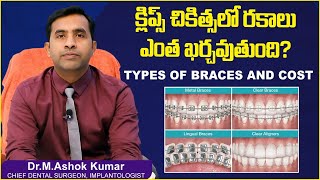 క్లిప్స్ చికిత్స రకాలు| Types of Braces in Telugu | Dental Treatment Cost | Eledent Dental Hospitals