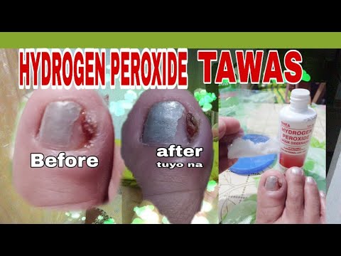 HOW TO REMOVE INGROWN HOME REMEDIES|* HYDROGEN PEROXIDE* |* TAWAS(madam lyn vlogger)