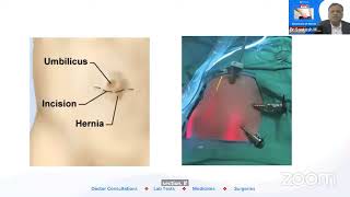 QnA on Hernia: Ask a Doc