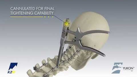 Stryker (K2M): YUKON OCT Spinal System Product Animation