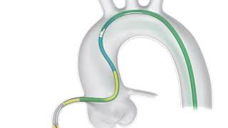 TrapLiner® Catheter Deployment