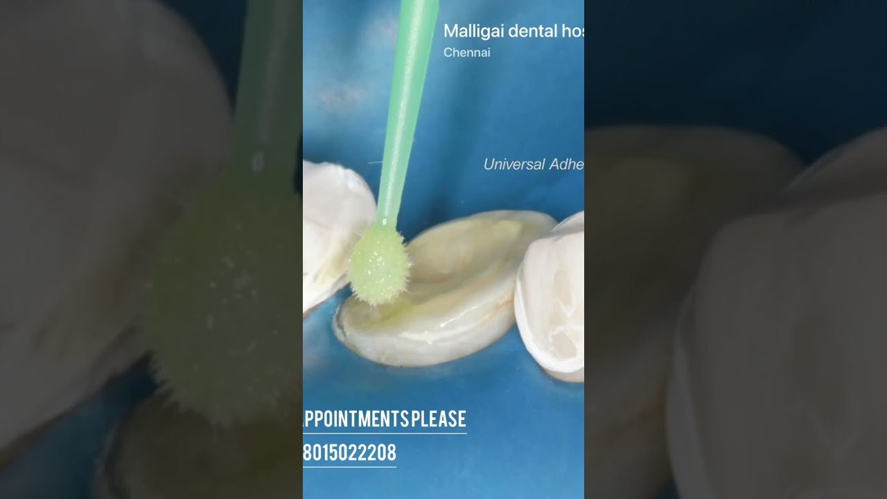Onlay crowns why? How? Advantages and disadvantages #onlays #dentalcrowns