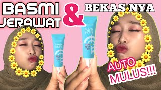 3 Hari Jerawat & Bruntusan Hilang?! | Skincare Routine untuk Wajah Berjerawat & Bruntusan