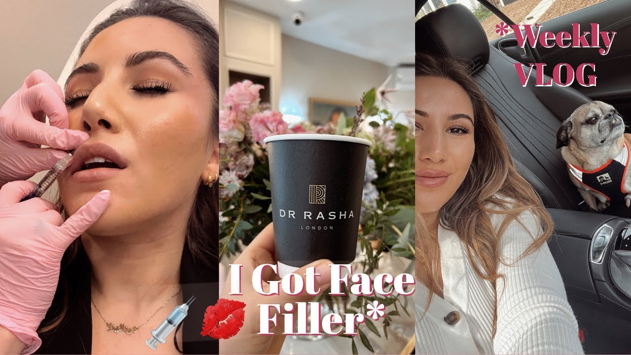 I GOT LIP & TEMPLE FILLER INJECTIONS** | WEEKLY VLOG | Mona's Eyes Beauty