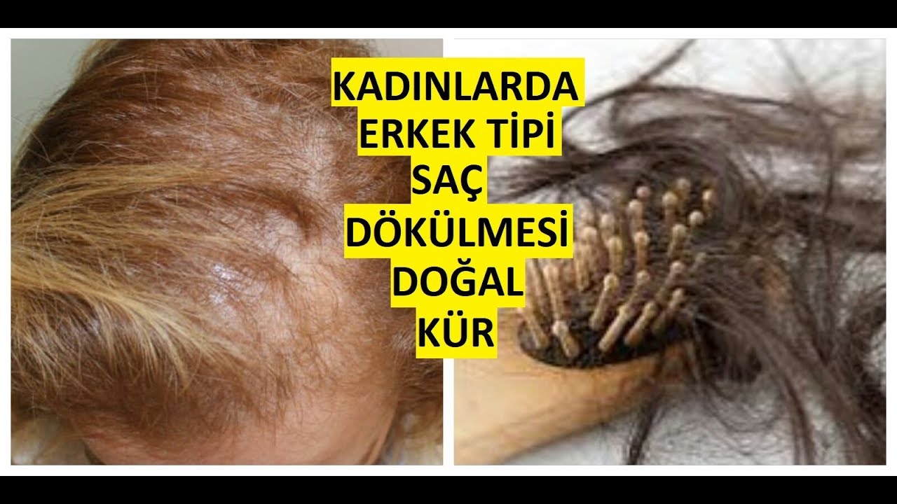 kadinlarda erkek tipi sac dokulmesi dogal kur saracoglu youtube sac dokulmesi sac sac maskeleri