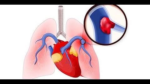 THUYÊN TẮC HUYẾT KHỐI TĨNH MẠCH (VENOUS THROBOEMBOLISM) (GS.TS.BSCKII.NS.PHẠM VINH QUANG)