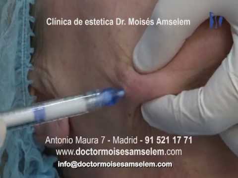 botox meaning Tratamiento flacidez del ovalo facial con Radiesse