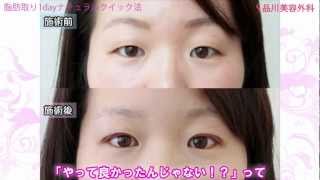 腫れぼったいまぶたを自然な二重に 痛みとハレを最小限に抑えます Youtube
