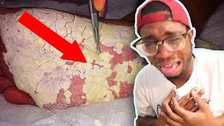 DISGUSTING FOOT FUNGUS DISEASE !!! (you will throw up)