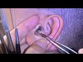 耳掃除 귀 청소 Ear Cleaning #96