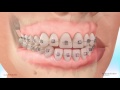 Carriere® Motion™ Appliance for Class III Correction - Patient Education Animation