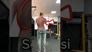 Scoliosi: esercizio 'correttivo' in questo #shorts