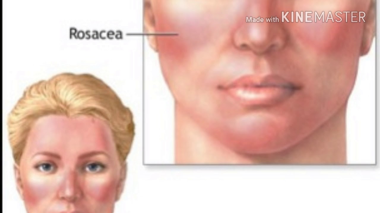 Розацеа Схема Лечения У Женщин Фото – Telegraph