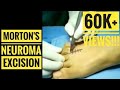 Mortons neuroma excision detailed surgical