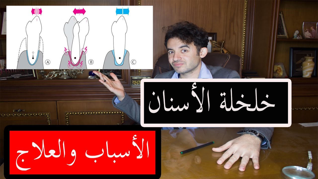 خلخلة الأسنان