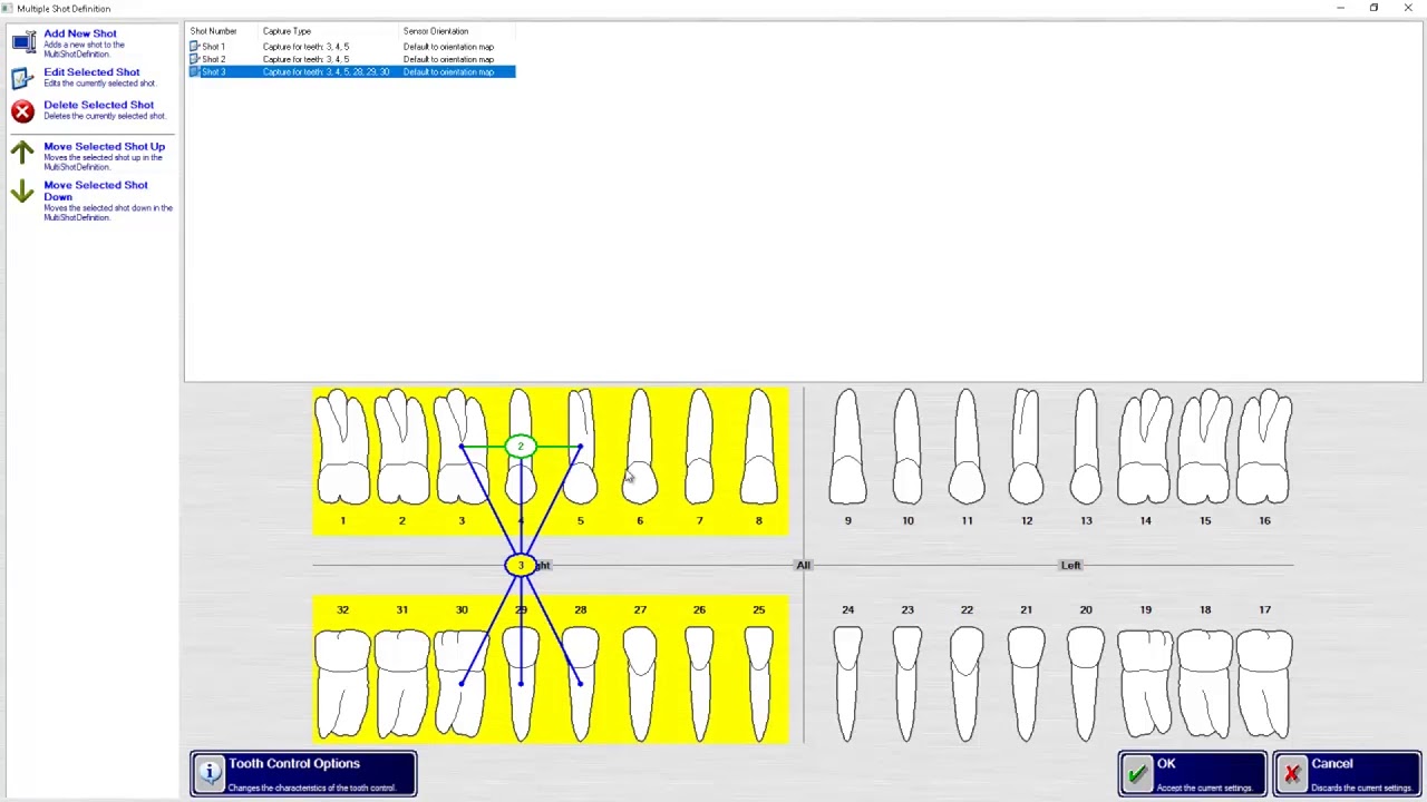 Xrayvision Software Training: Apteryx XrayVision DCV: Acquiring a Multiple PA Progression ...