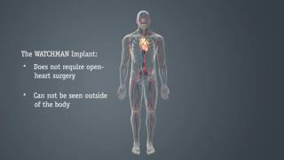 Cardiovascular WATCHMAN™ to Reduce AFib Stroke Risk