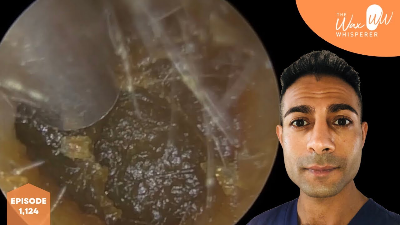 1,124 Deeply Impacted & Blocked Ear Wax Removal YouTube