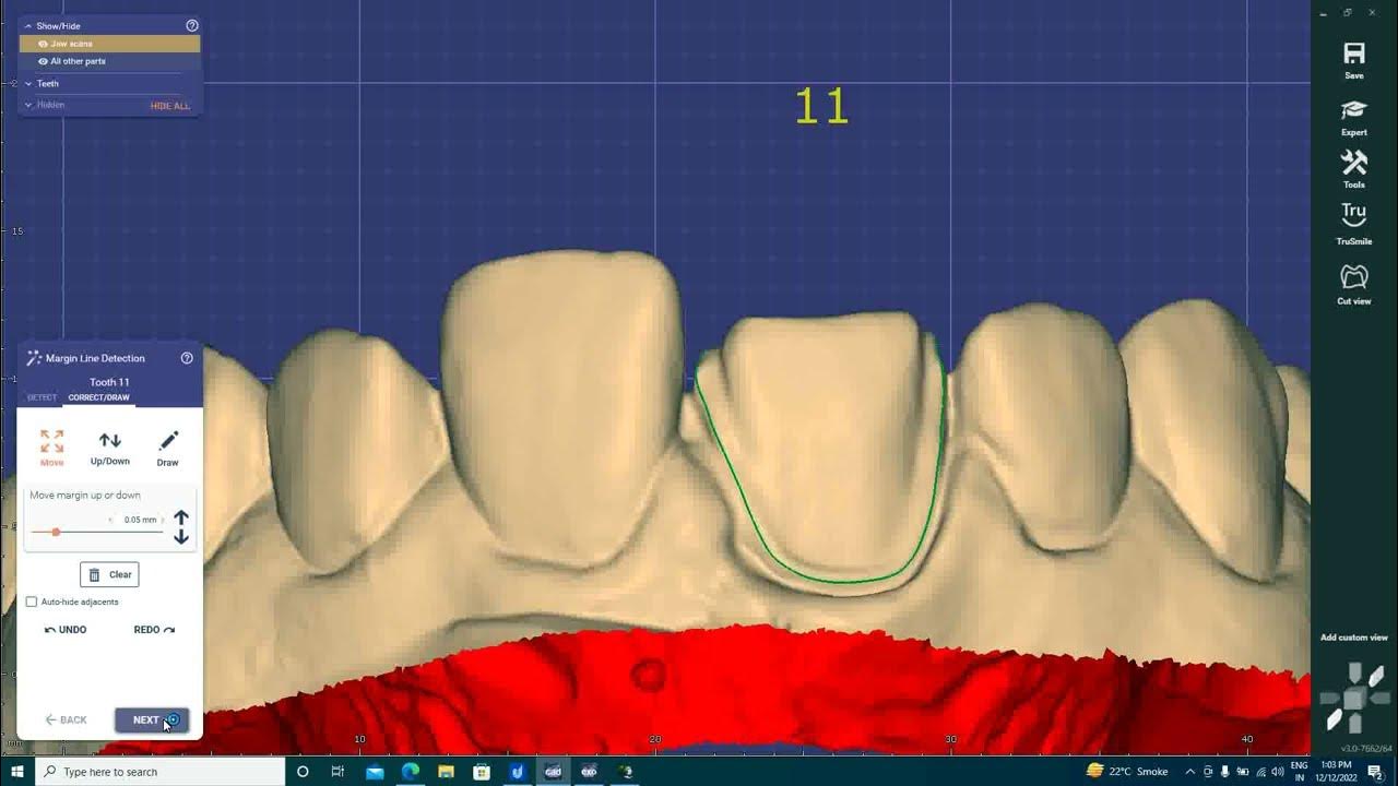 cad cam/CAD/CAM: Making of Dental Veneers (Laboratory)E.max - YouTube