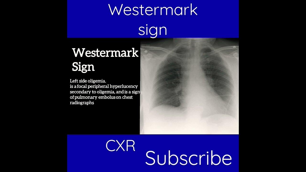 Cxr westermark sign radiology review youtube