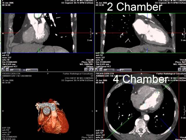 Coronary Ct Angiography Rca Stenosis Youtube