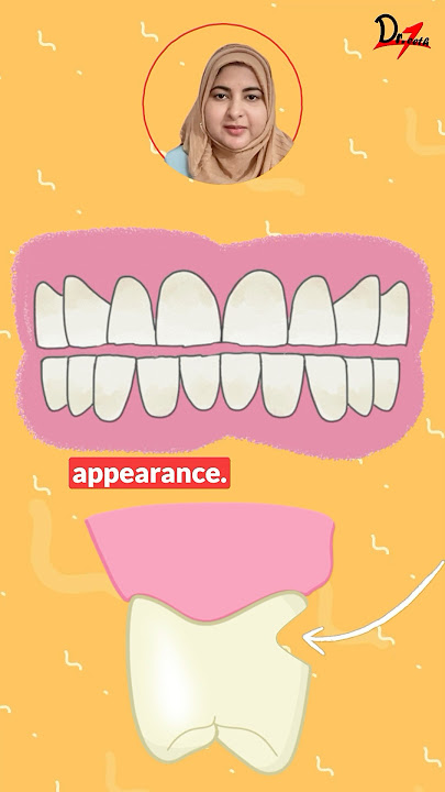 Abfraction or Abrasion? Can you differentiate?