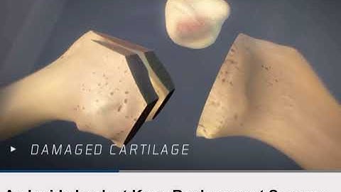 TOTAL KNEE REPLACEMENT VISUAL