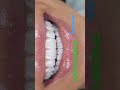 циркониевые коронки на передние зубы #стоматологкраснодар  #винирыназубы #коронкиназубы #shorts