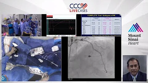 Impella Assisted Protected Multivessel PCI using Rotational Atherectomy - Sept 2019