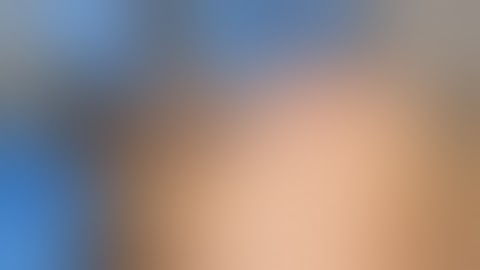 Modified biopsy of a squamous cell cancer on the forehead