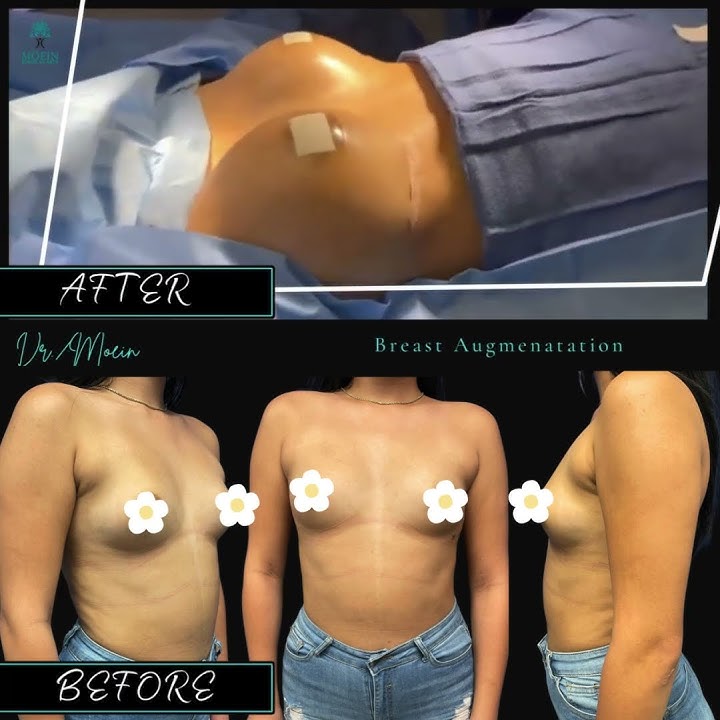 Tummy Tuck Revision Surgery - Moein Surgical Arts