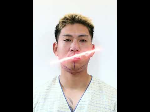 Невероятное Преображение До и После ( Блефаропластика, Ринопластика, Челюстно-лицевая пластика)