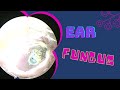 FUNGAL INFECTION EAR (OTOMYCOSIS)