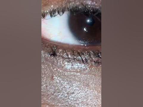 Suture Removal on Blepharoplasty - YouTube