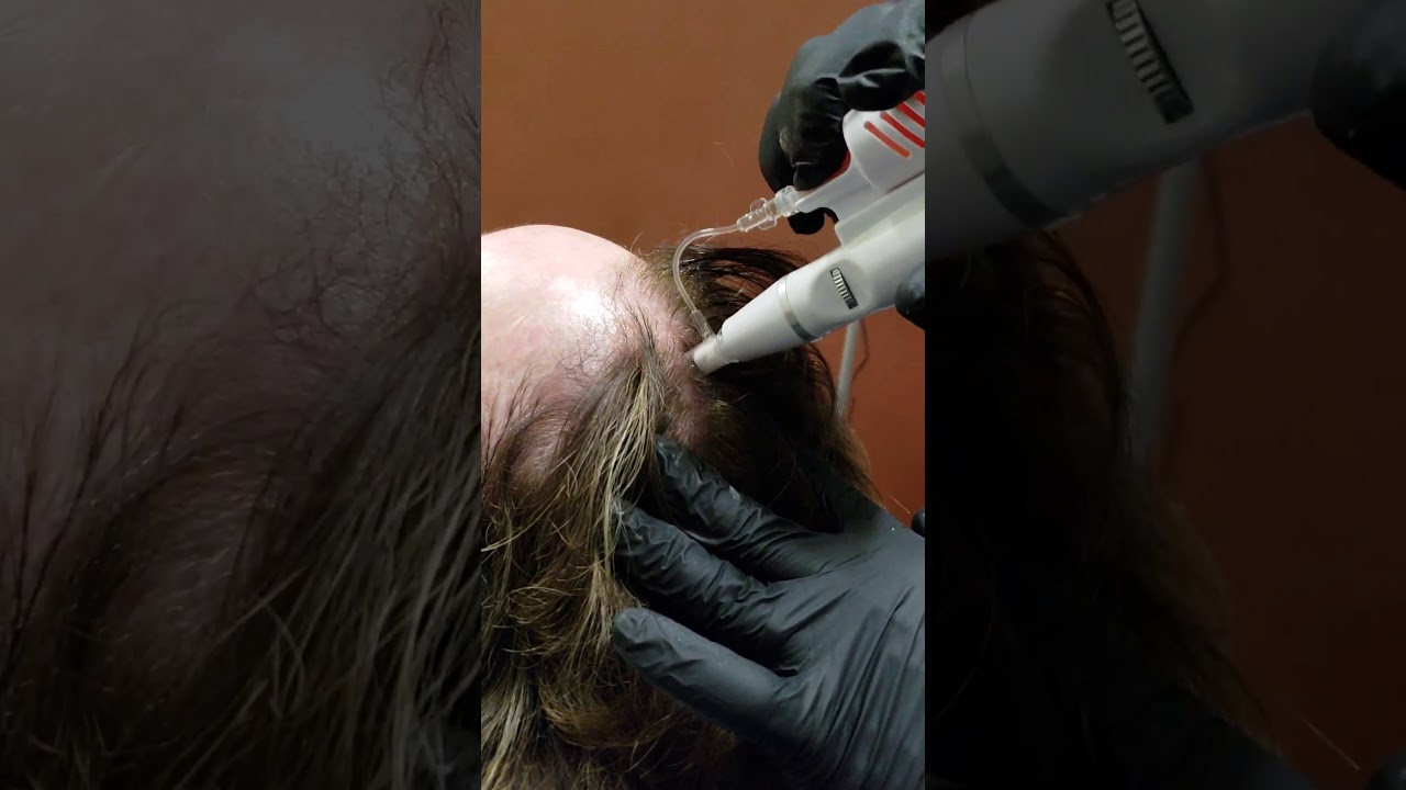 Advanced Microneedling PRP Hair Restoration Vintage Lashes Naples