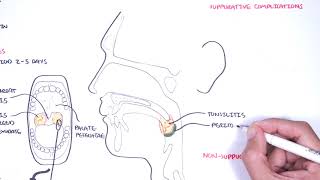 Strep throat (streptococcal pharyngitis) pathophysciology, signs and symptoms, diagnosis, treatment