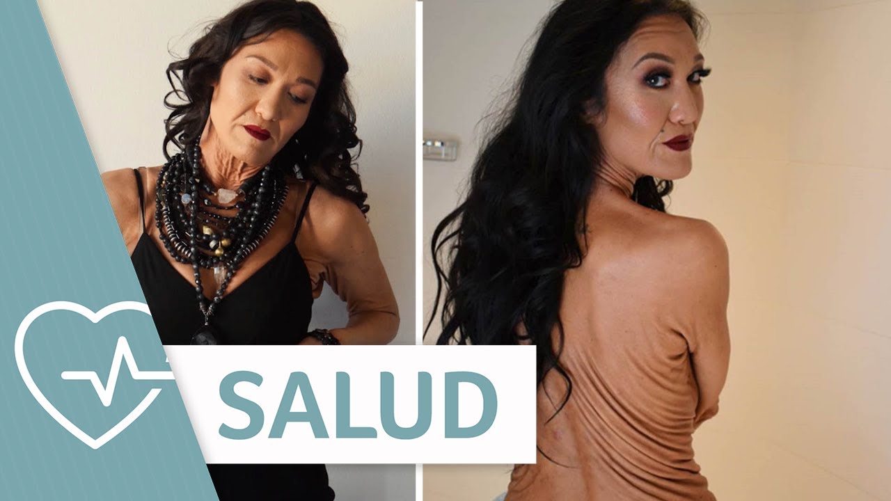 Modelo con rara condición en la piel rompe estándares de belleza | Salud | Telemundo Lifestyle video phone beyonce mp3