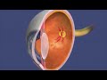 (Audio Description) Animation: Retinopathy of Prematurity