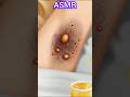 Extreme Ear Wax Removal ASMR 👂🤯 | Relaxing Deep Cleaning Sounds #asmr