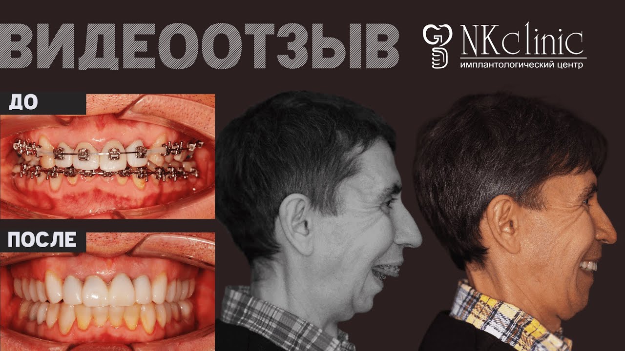 Увеличили маленькую нижнюю челюсть (дистальный прикус)? Отзыв после ортогнатической операции