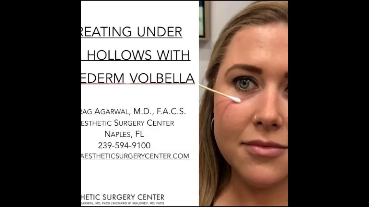 Treating Under Eye Hollows with Juvederm Volbella by Dr. Agarwal YouTube