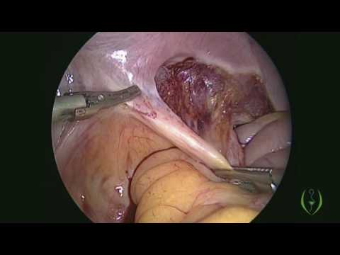 Laparoscopic Radical Hysterectomy With Pelvic Lymph Node Dissection