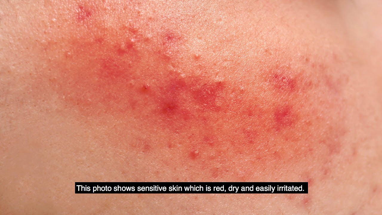 Assess Well - Technical Unit 2 Principles of dermatology, nutrition - Captions