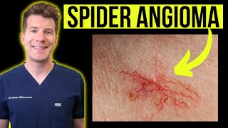 Doctor Explains Spider Angioma Aka Spider Nevustelangiectasia Causes, Photos, Treatments