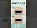 밸런스랩 아웃핏 1달차💖 #밸런스랩성형외과 #아웃핏타이트 #팔뚝아웃핏 #아웃핏후기