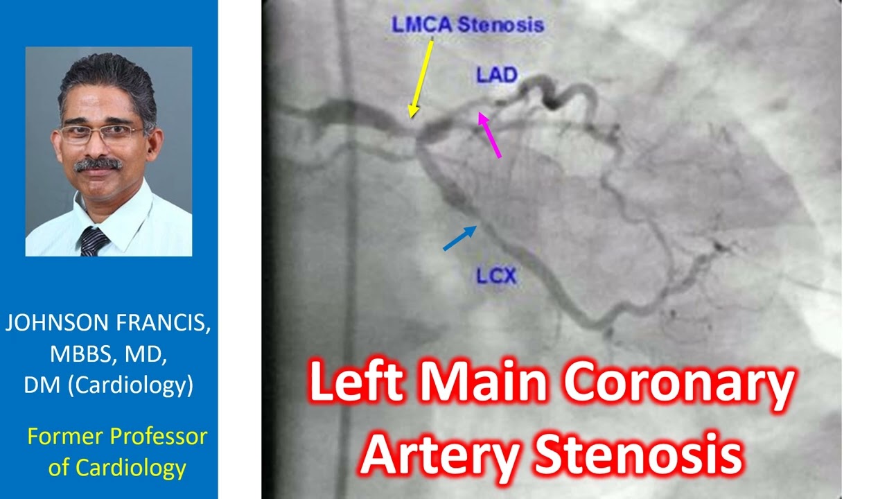 Left main coronary artery stenosis
