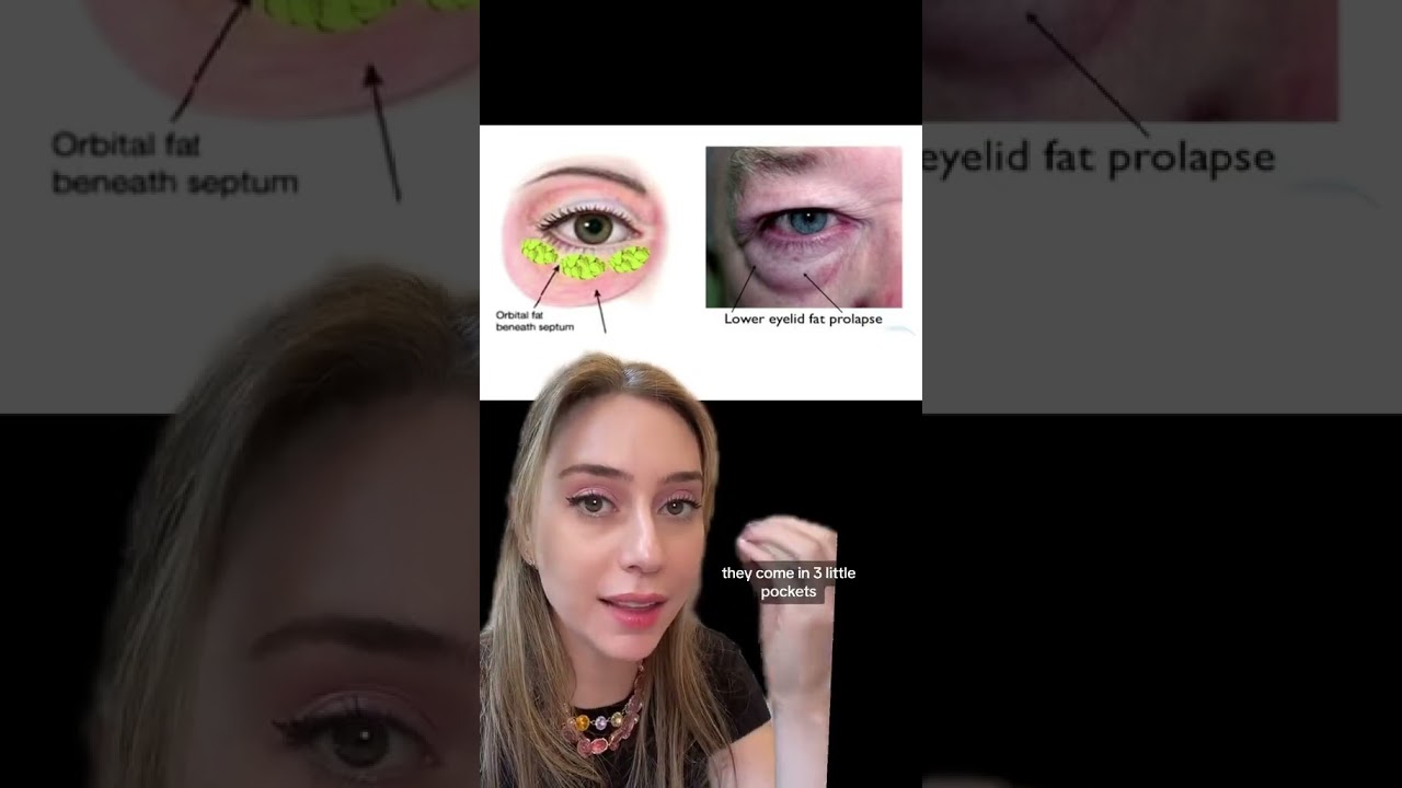 Under Eye Bags #shorts