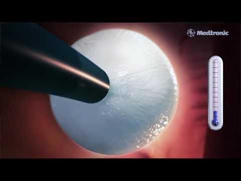 Crioablación: la cirugía que trata la fibrilación auricular con frío
