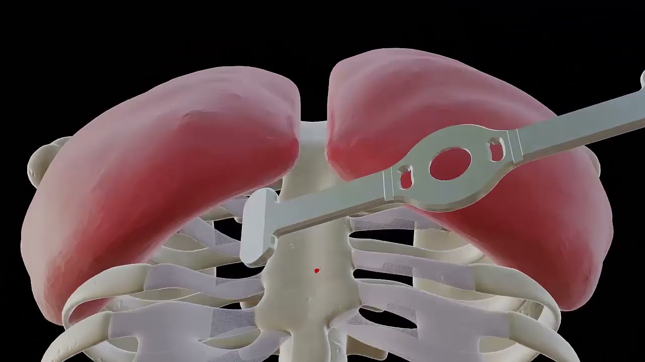 Pectus Up - Surgical technique