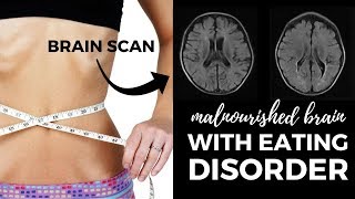 How MALNUTRITION Affects Your BRAIN // Eating Disorder Recovery